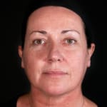 After dermal fillers, addressing sagging cheeks.