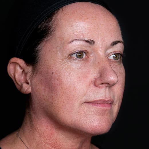 After dermal fillers, addressing sagging cheeks.