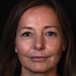 Before facial fillers including lip augmentation, addressing lip lines, marionette lines, thin lips, reduced lip volume, and lipstick/smokers' lines.