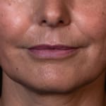 Before facial fillers including lip augmentation, addressing lip lines, marionette lines, thin lips, reduced lip volume, and lipstick/smokers' lines.