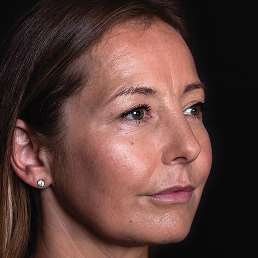 Before facial fillers including lip augmentation, addressing lip lines, marionette lines, thin lips, reduced lip volume, and lipstick/smokers' lines.