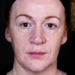 ChatGPT said: Before fillers, addressing nose-to-mouth lines (laughter lines)