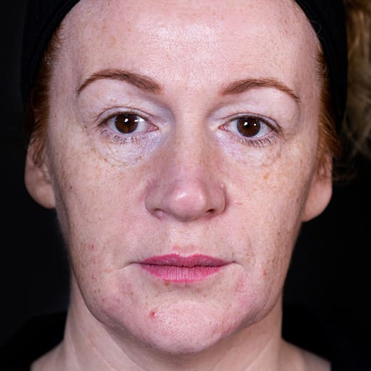 ChatGPT said: Before fillers, addressing nose-to-mouth lines (laughter lines)