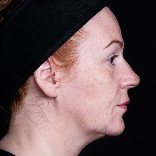 ChatGPT said: Before fillers, addressing nose-to-mouth lines (laughter lines)