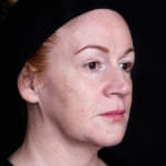 ChatGPT said: Before fillers, addressing nose-to-mouth lines (laughter lines)