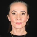 After full facelift with deep plane face and neck lift and jowl lift, addressing sagging neck, sagging jawline, and sagging jowls