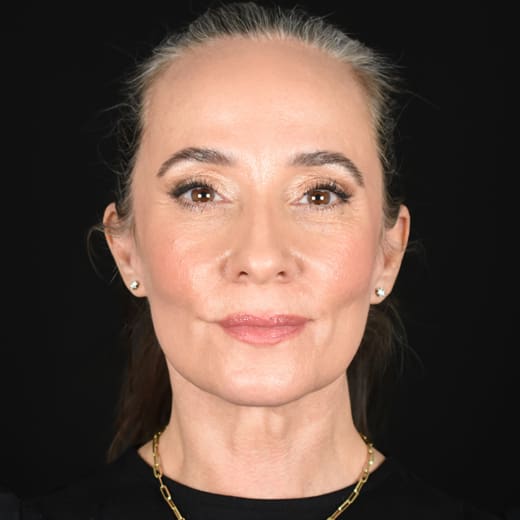After full facelift with deep plane face and neck lift and jowl lift, addressing sagging neck, sagging jawline, and sagging jowls