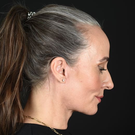 After full facelift with deep plane face and neck lift and jowl lift, addressing sagging neck, sagging jawline, and sagging jowls