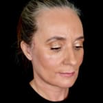 After full facelift with deep plane face and neck lift and jowl lift, addressing sagging neck, sagging jawline, and sagging jowls