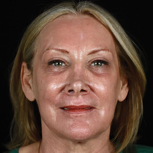 After full laser resurfacing, addressing lipstick lines and smokers' lines.
