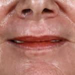 After full laser resurfacing, addressing lipstick lines and smokers' lines.