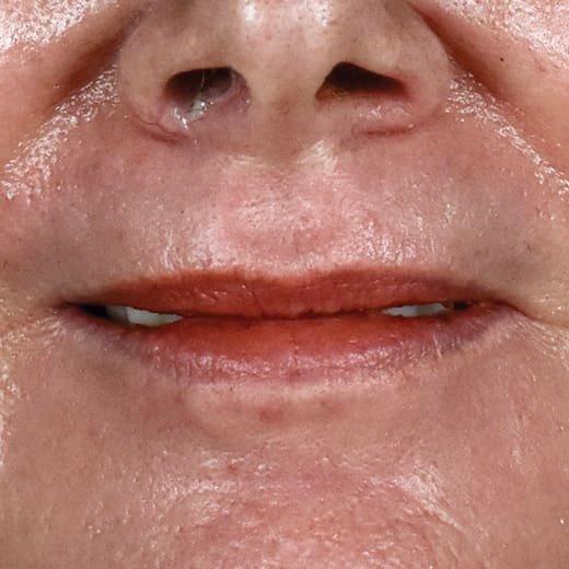 After full laser resurfacing, addressing lipstick lines and smokers' lines.