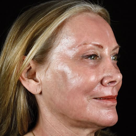 After full laser resurfacing, addressing lipstick lines and smokers' lines.