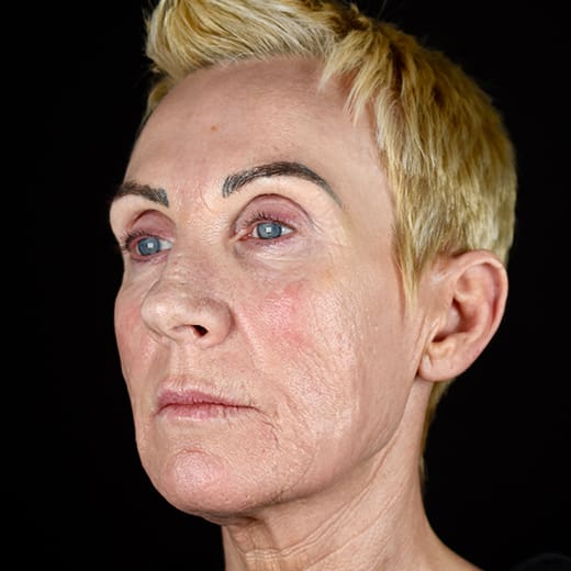 After full laser resurfacing, addressing scars and scarring