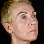 After full laser resurfacing, addressing scars and scarring