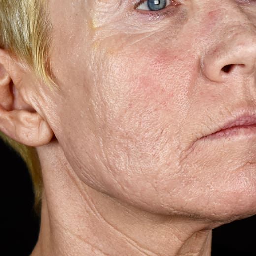 After full laser resurfacing, addressing scars and scarring