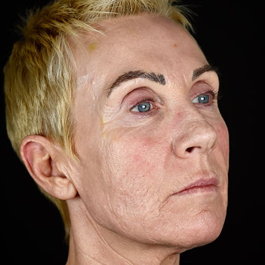 After full laser resurfacing, addressing scars and scarring