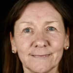 After full laser skin resurfacing, addressing fine lines and wrinkles in the lower cheek.