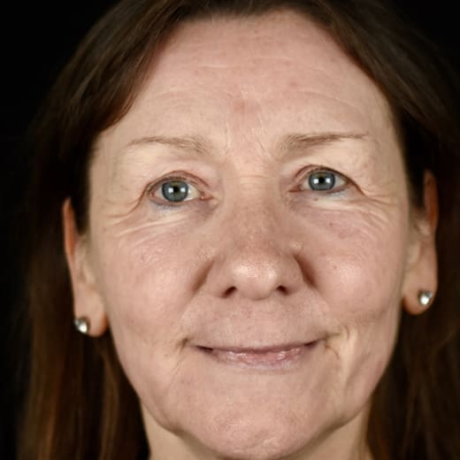 After full laser skin resurfacing, addressing fine lines and wrinkles in the lower cheek.