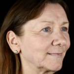 After full laser skin resurfacing, addressing fine lines and wrinkles in the lower cheek.