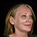 After full laser skin resurfacing, addressing lower cheek wrinkles and rough skin.