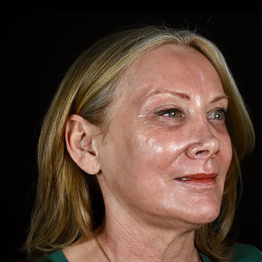 After full laser skin resurfacing, addressing lower cheek wrinkles and rough skin.