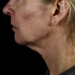 After jowl lift with chin and jaw filler, addressing sagging neck and sagging jawline