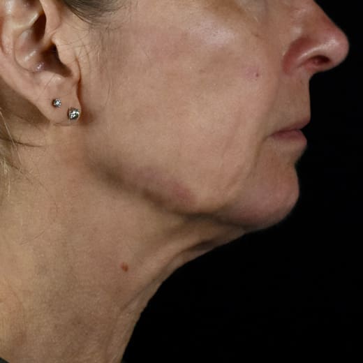 After jowl lift with chin and jaw filler, addressing sagging neck and sagging jawline