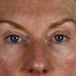 After laser eye lift and filler treatment, addressing volume loss and under-eye bags.