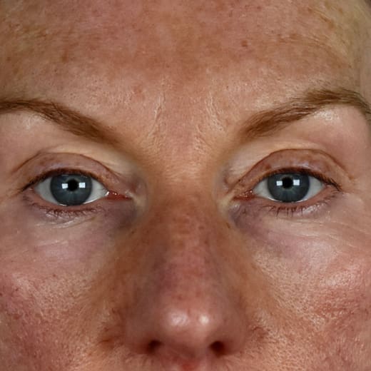 After laser eye lift and filler treatment, addressing volume loss and under-eye bags.