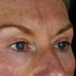 After laser eye lift and filler treatment, addressing volume loss and under-eye bags.
