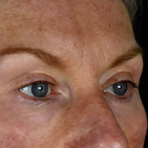 After laser eye lift and filler treatment, addressing volume loss and under-eye bags.