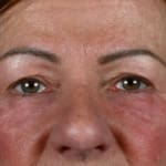 After laser eye lift, addressing under-eye bags.