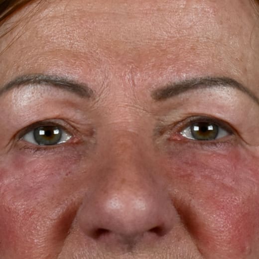 After laser eye lift, addressing under-eye bags.
