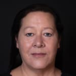 After lip and cheek filler, addressing lipstick / smokers' lines.