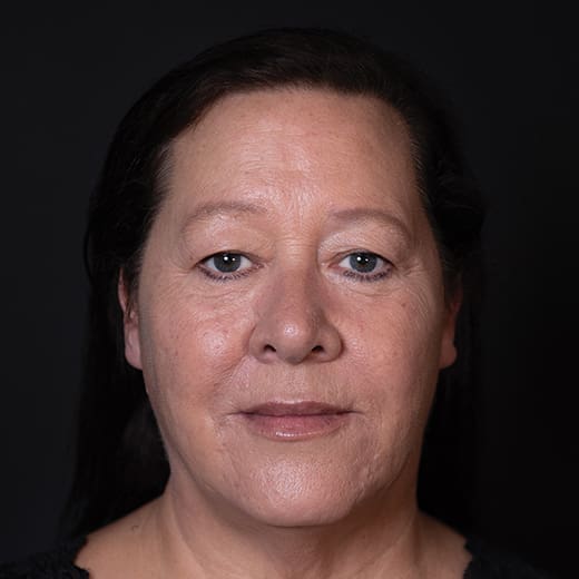 After lip and cheek filler, addressing lipstick / smokers' lines.