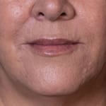 Before lip and cheek filler, addressing lipstick / smokers' lines.