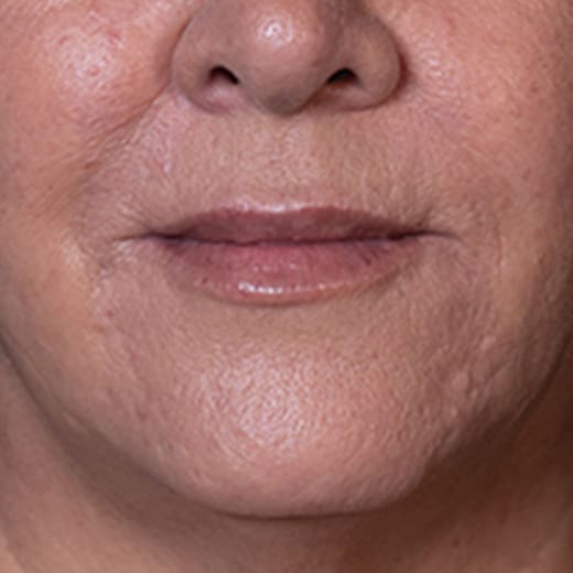 Before lip and cheek filler, addressing lipstick / smokers' lines.