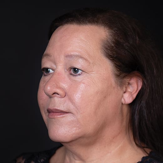 After lip and cheek filler, addressing lipstick / smokers' lines.