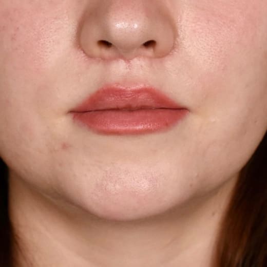 After lip lift, addressing a long upper lip