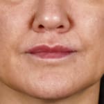 After lip lift, addressing a long upper lip