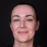 Before non-surgical eye lift with wrinkle-relaxing injections, addressing heavy upper eyelids.