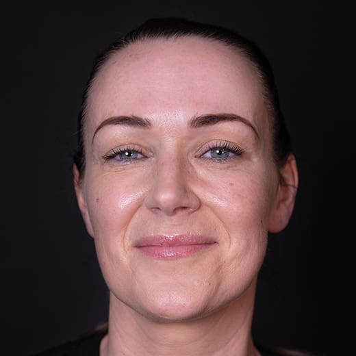 Before non-surgical eye lift with wrinkle-relaxing injections, addressing heavy upper eyelids.