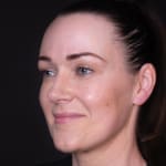 After non-surgical eye lift with wrinkle-relaxing injections, addressing heavy upper eyelids.