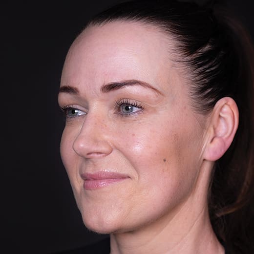 After non-surgical eye lift with wrinkle-relaxing injections, addressing heavy upper eyelids.