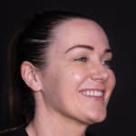 Before non-surgical eye lift with wrinkle-relaxing injections, addressing heavy upper eyelids.