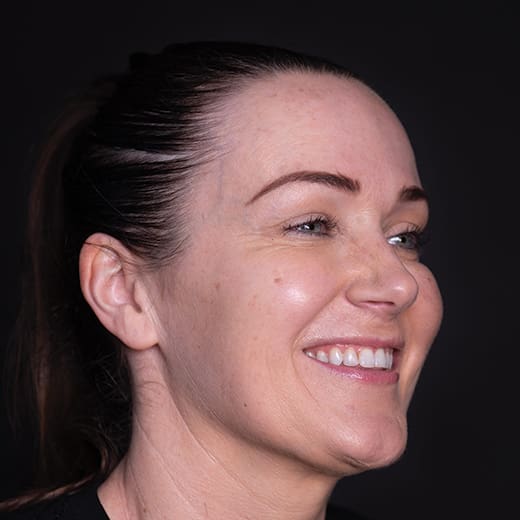 Before non-surgical eye lift with wrinkle-relaxing injections, addressing heavy upper eyelids.