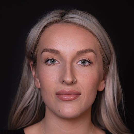 After non-surgical rhinoplasty with chin and jaw filler, to address a prominent nose and imbalanced chin projection.