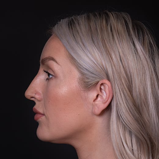 After non-surgical rhinoplasty with chin and jaw filler, to address a prominent nose and imbalanced chin projection.
