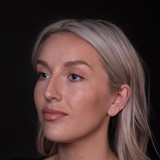 After non-surgical rhinoplasty with chin and jaw filler, to address a prominent nose and imbalanced chin projection.